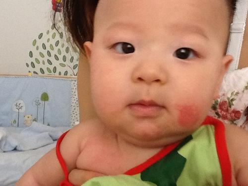 全自动母乳分析仪厂家宝宝容易得奶癣的原因及解决的办法 全自动母乳分析仪厂家宝宝容易得奶癣的原因及解决的办法
